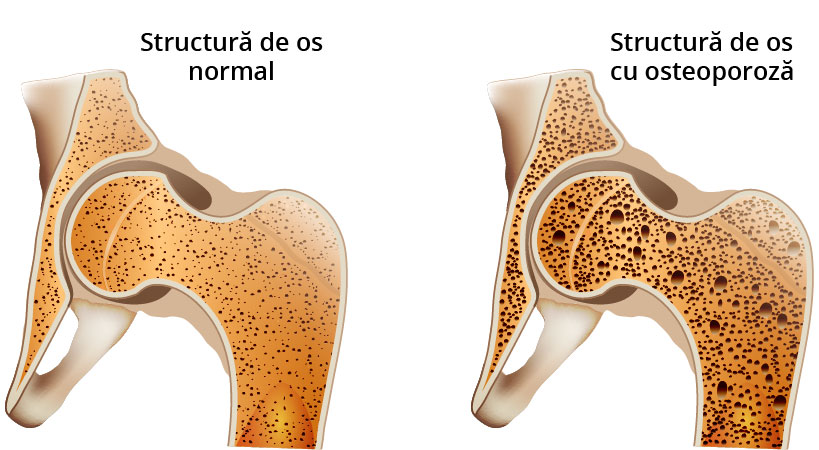 Tratamente naturiste pentru osteoporoza