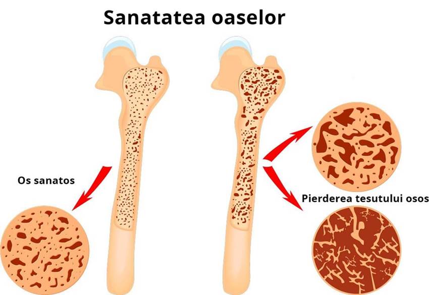 Alimente bogate in vitamina D si calciu pentru sanatatea oaselor