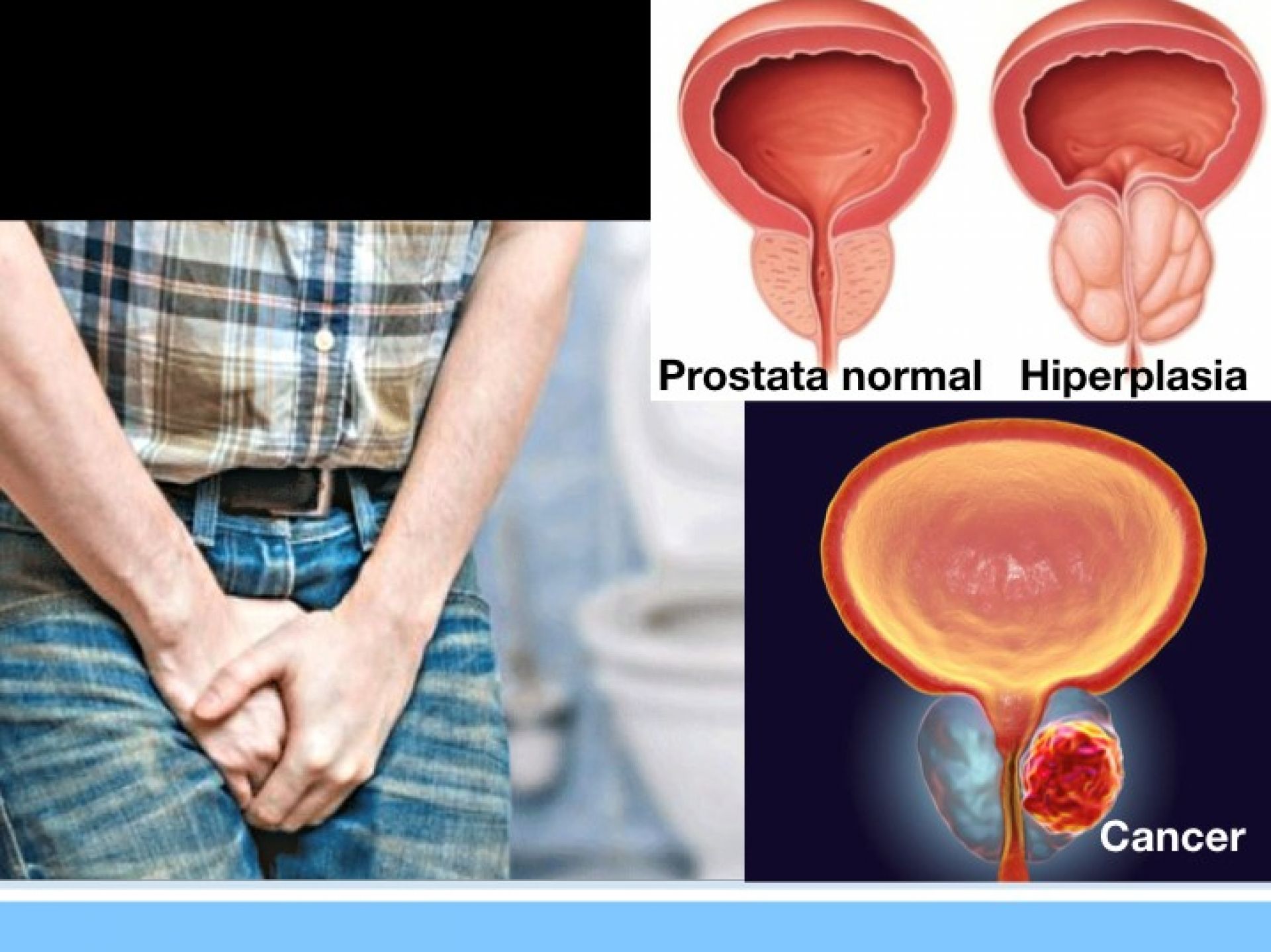 prostata